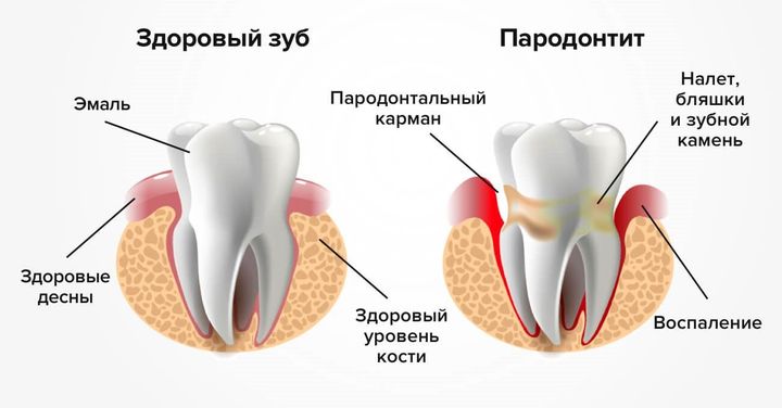 Парадонтит