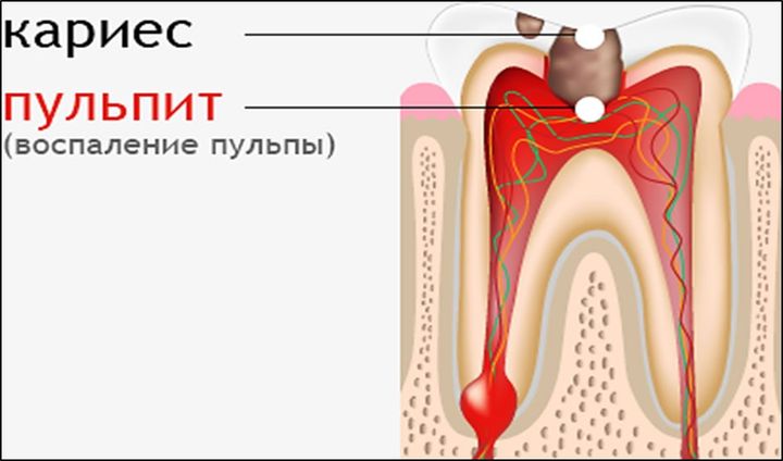Болезни зуба