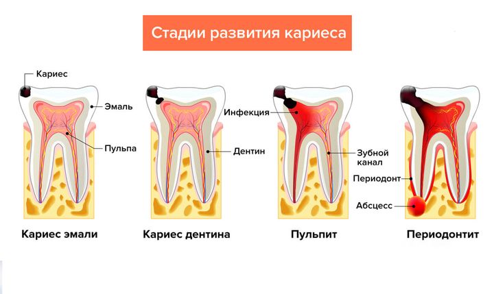 Стадии развития кариеса