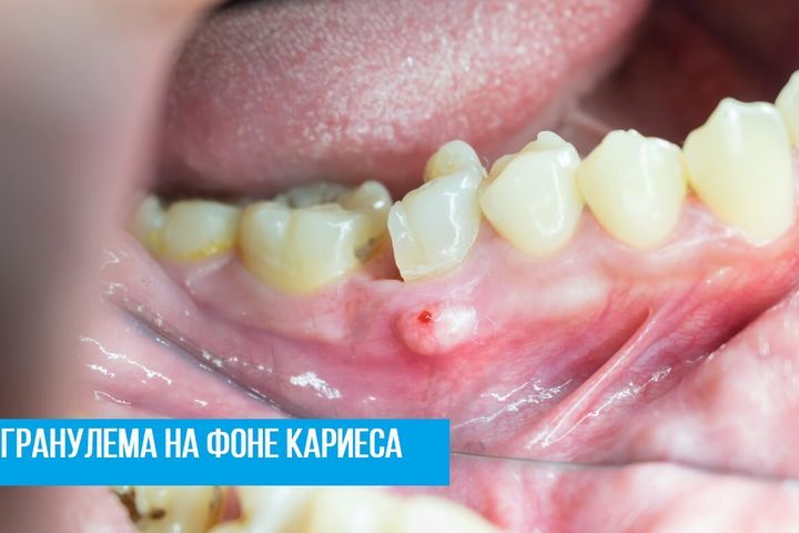 Гранулема на фоне кариеса