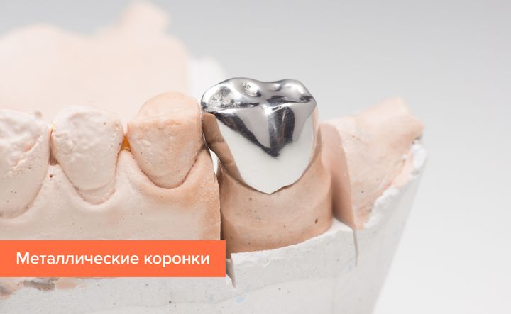 Металлические коронки