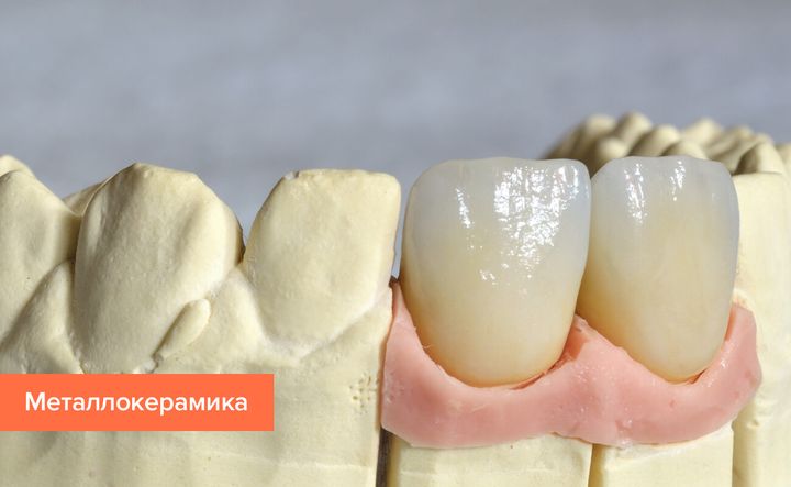 Коронки из металлокерамики
