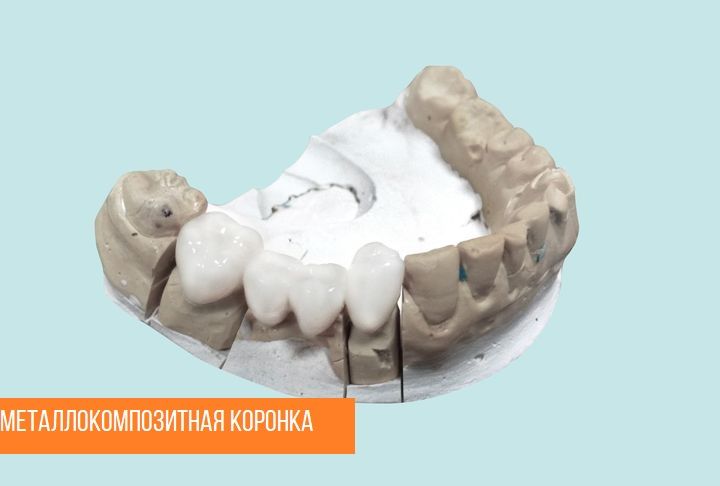 Коронки из металлокомпозита