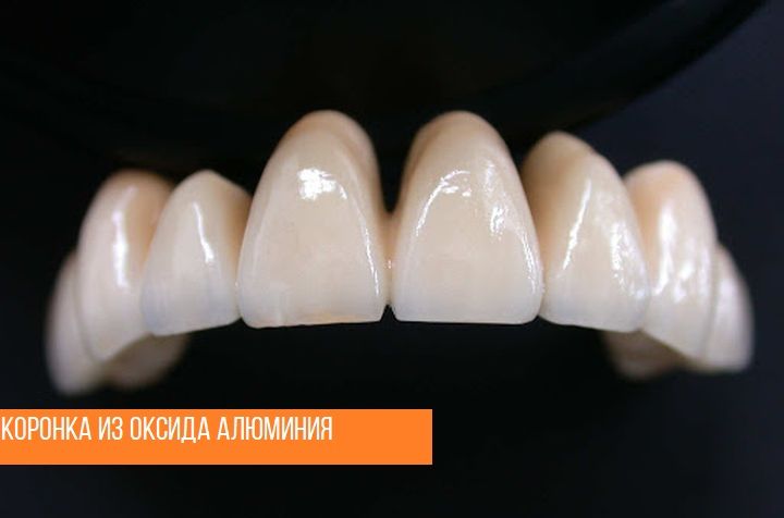 Коронки из оксида алюминия