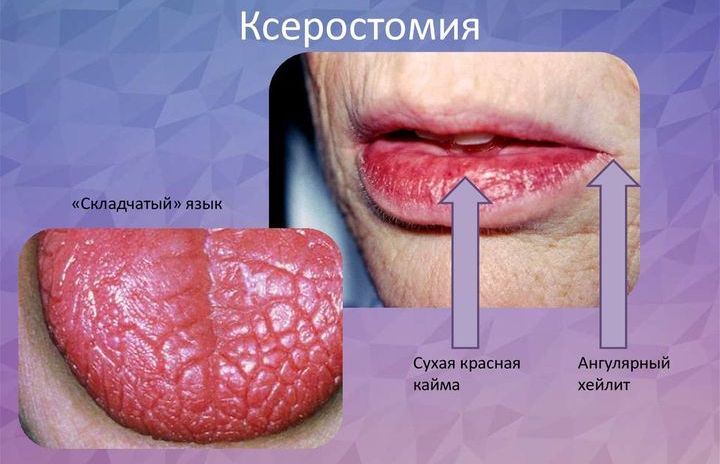 Ксеростомия