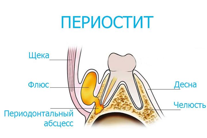 Что такое периостит