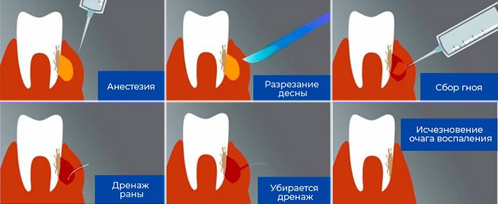 Хирургическое лечение периостита