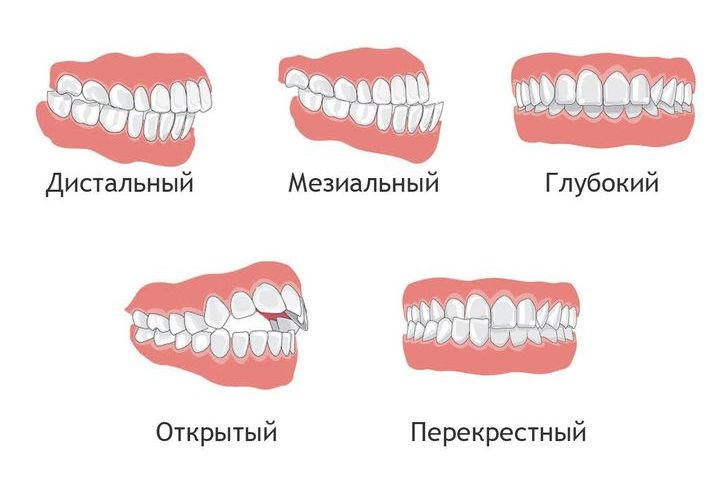 Виды неправильного прикуса