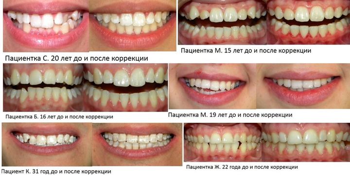 До и после брекетов